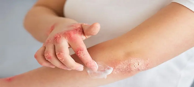 Το Ατοπικό Δέρμα και οι Ανάγκες του